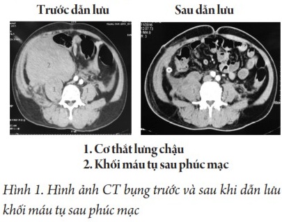 Xuất huyết sau phúc mạc - Hình ảnh minh họa